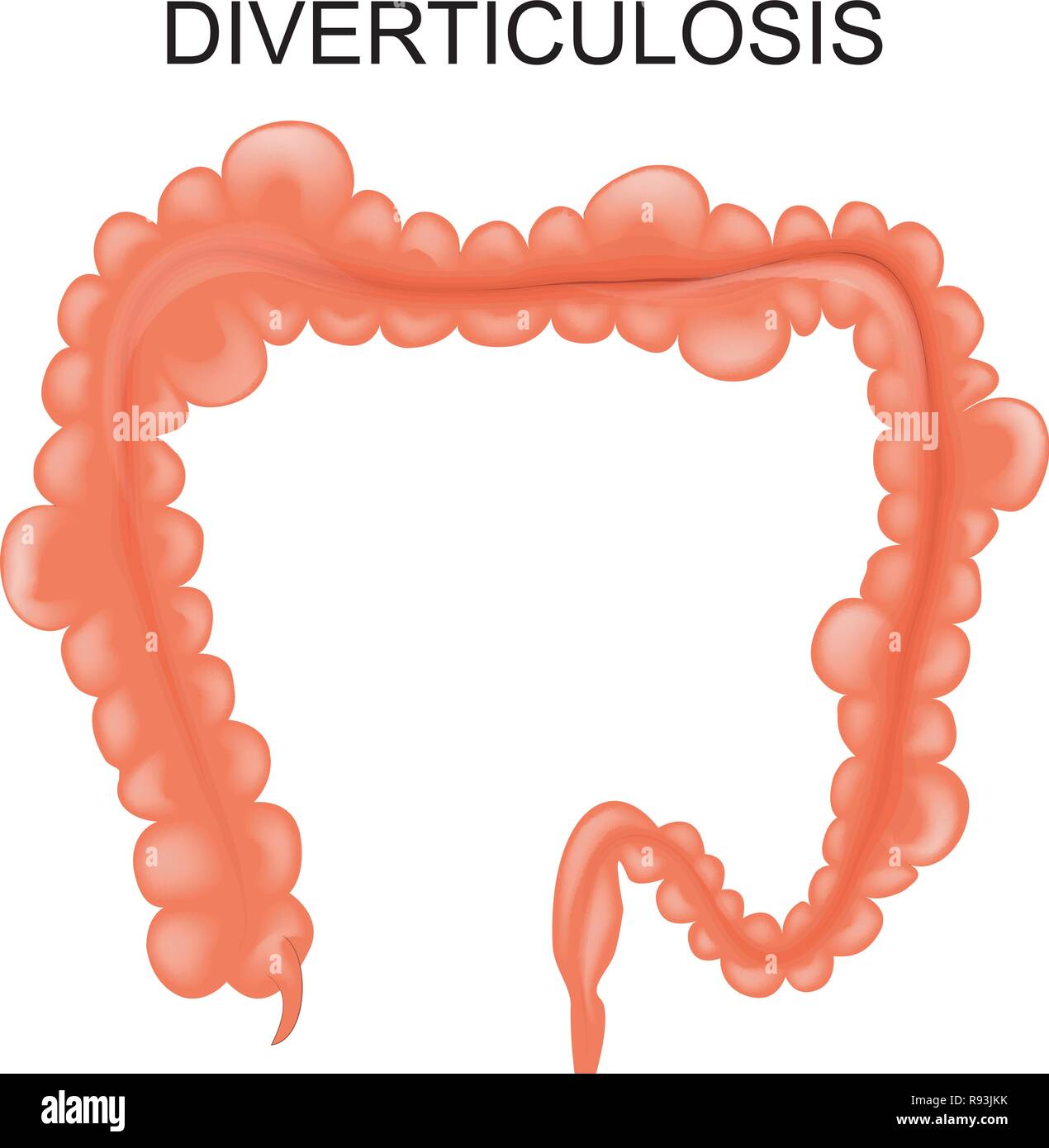 Illustrazione vettoriale di diverticolosi del colon Illustrazione Vettoriale