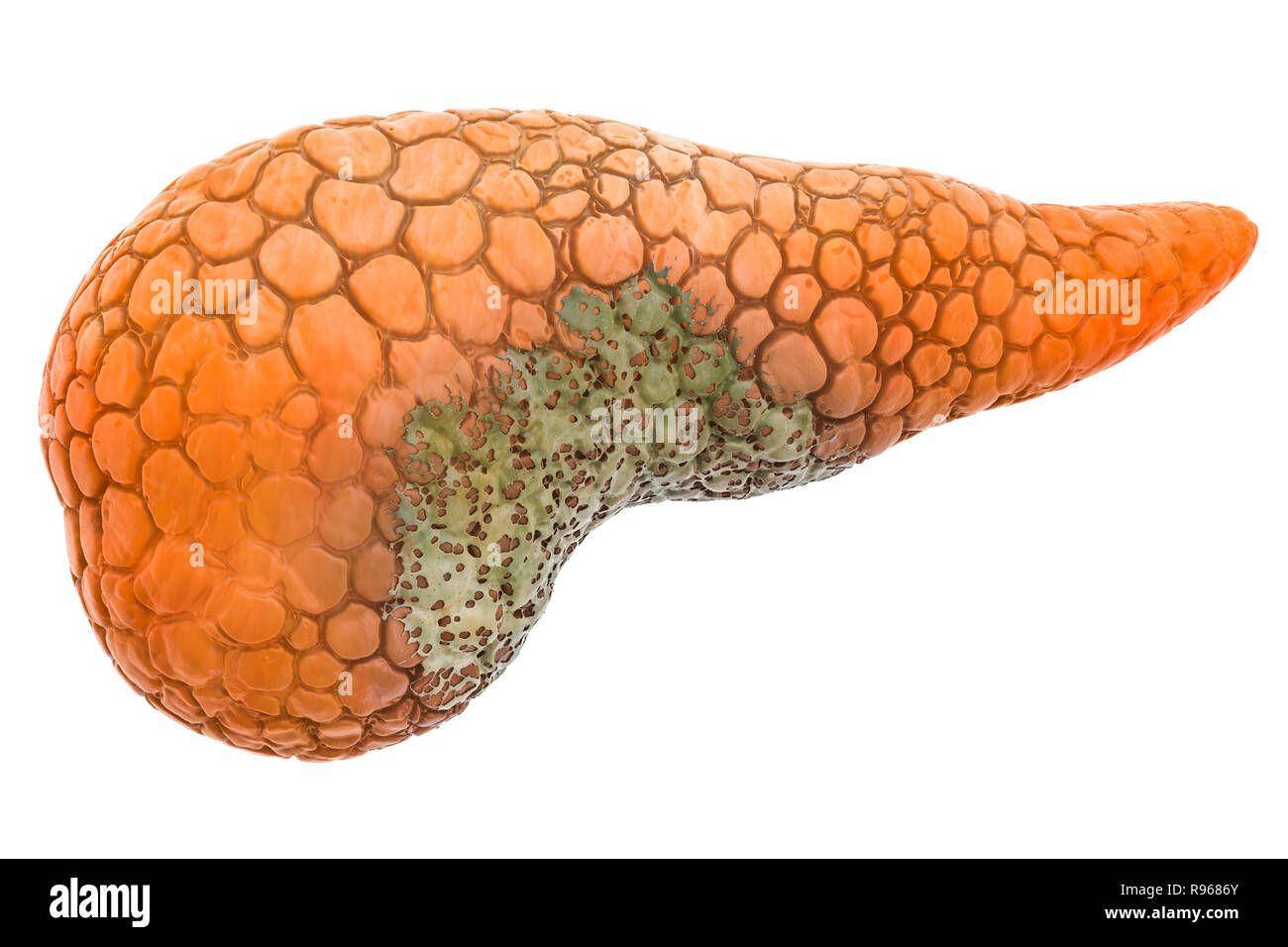 Malattia pancreatica concetto, 3D rendering isolati su sfondo bianco Foto Stock