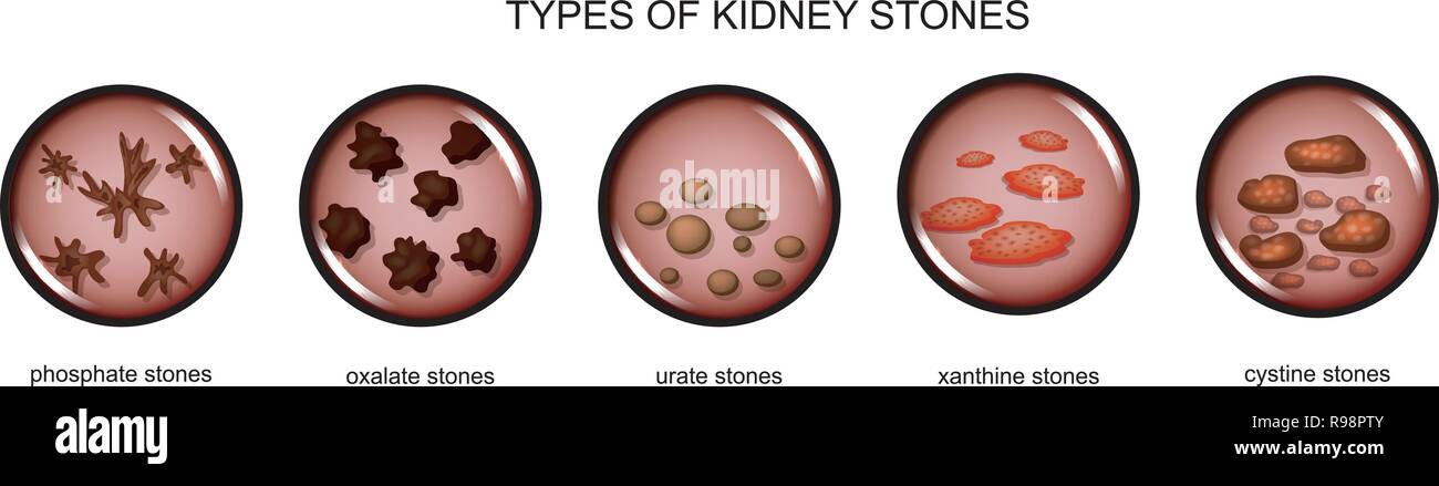 Illustrazione vettoriale di tipi di calcoli renali Illustrazione Vettoriale