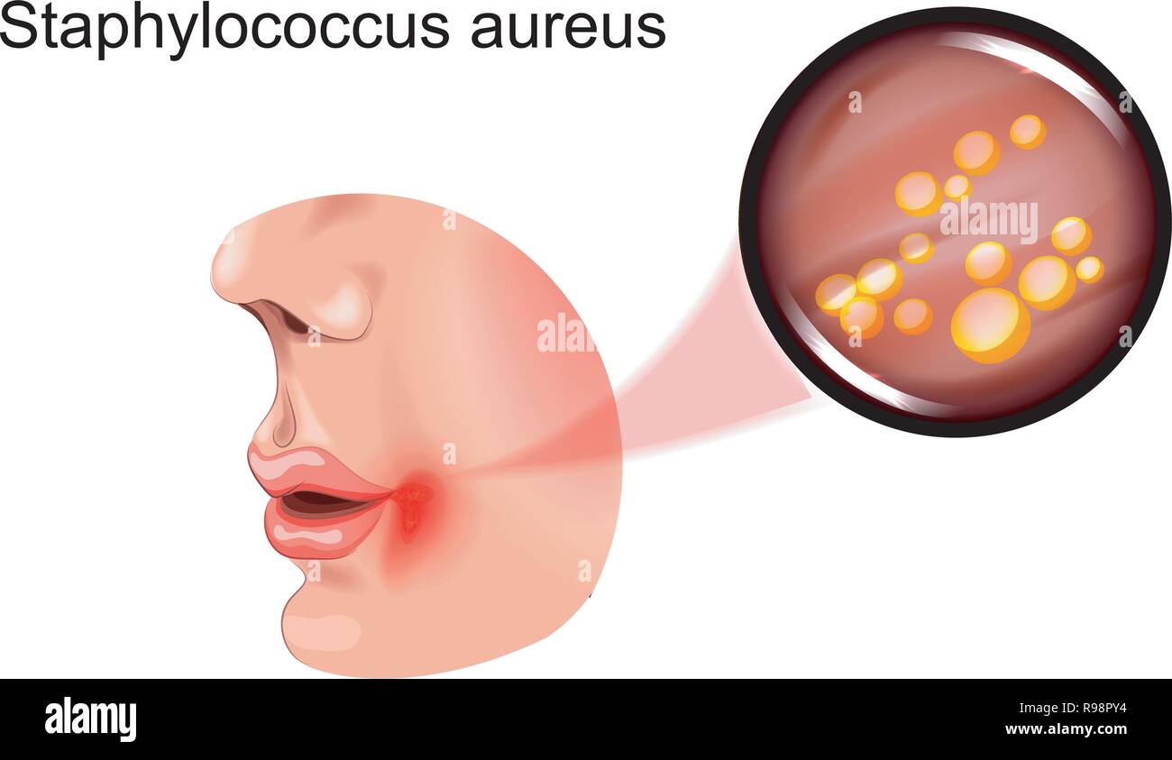 Illustrazione vettoriale di una piaga sul viso. staphylococcus Illustrazione Vettoriale