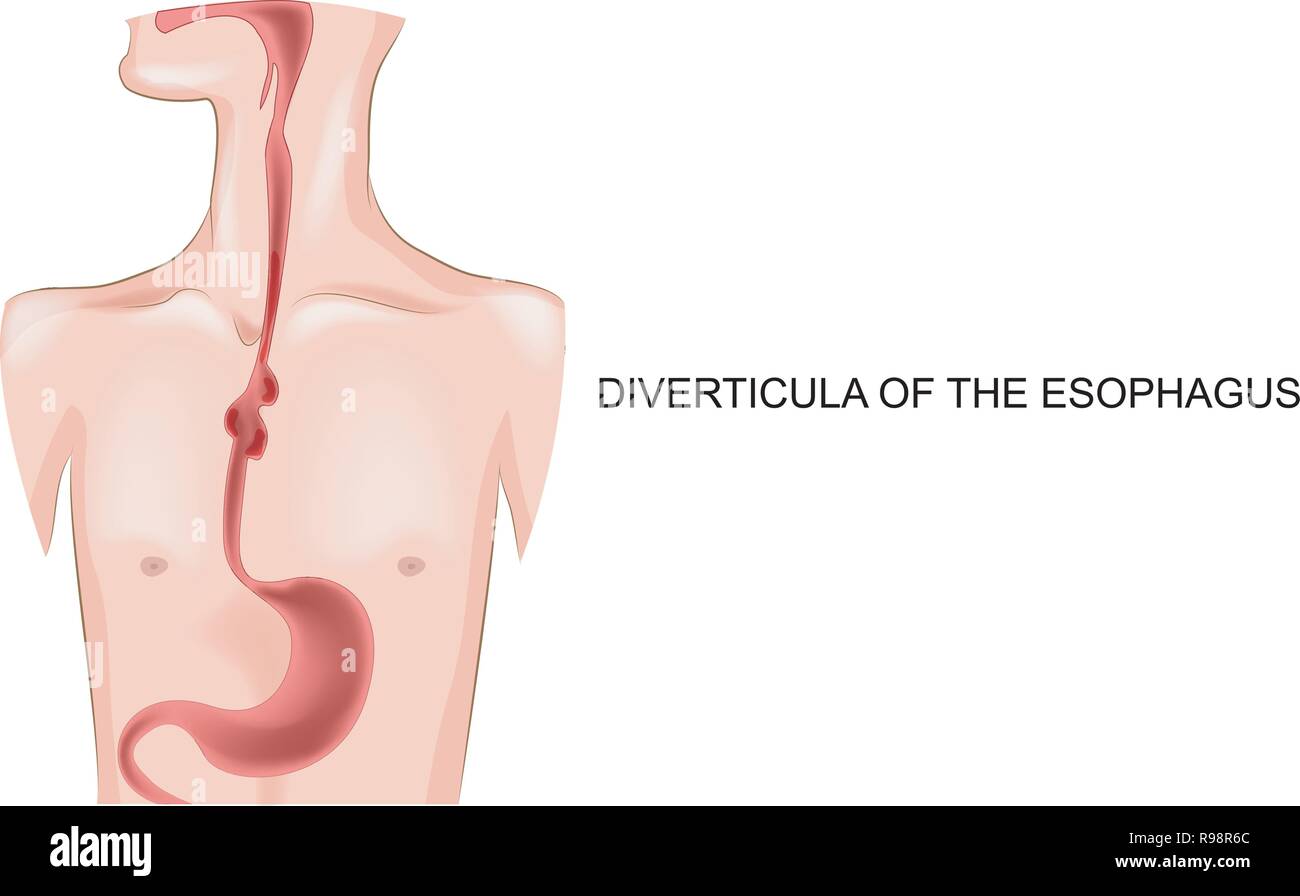 Illustrazione Vettoriale dei diverticoli dell'esofago Illustrazione Vettoriale