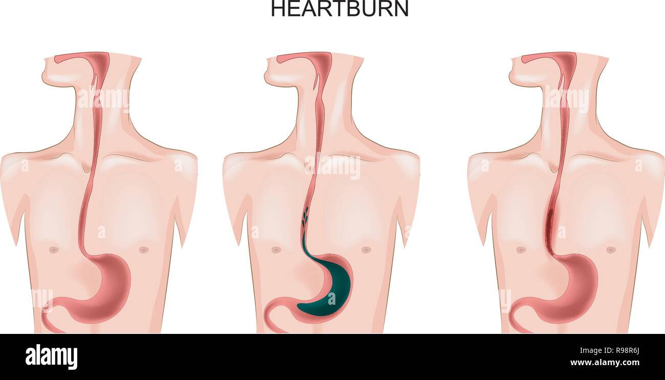 Illustrazione vettoriale di un esofago affetti da bruciori di stomaco Illustrazione Vettoriale