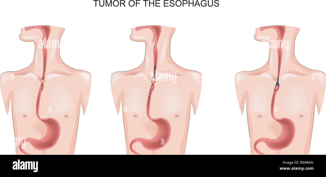 Illustrazione vettoriale di tumore all'esofago Illustrazione Vettoriale