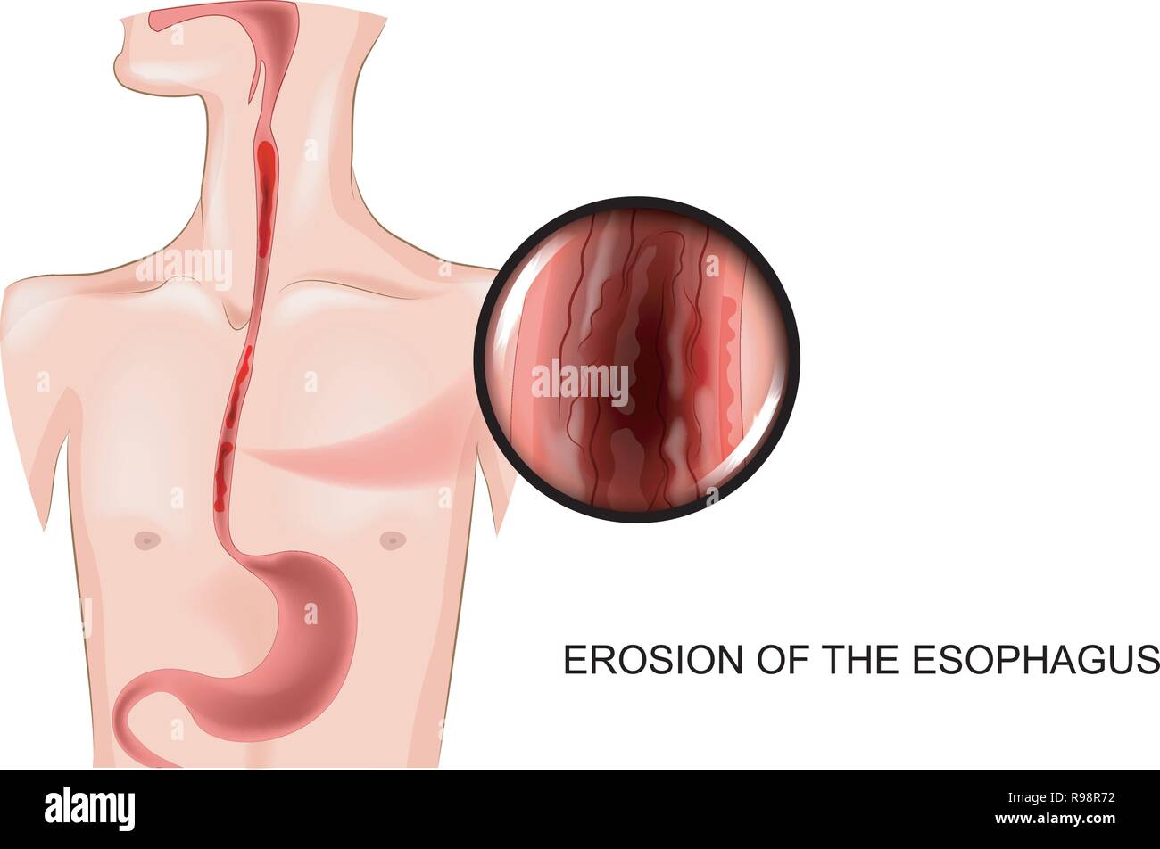 Illustrazione vettoriale di erosione dell'esofago Illustrazione Vettoriale