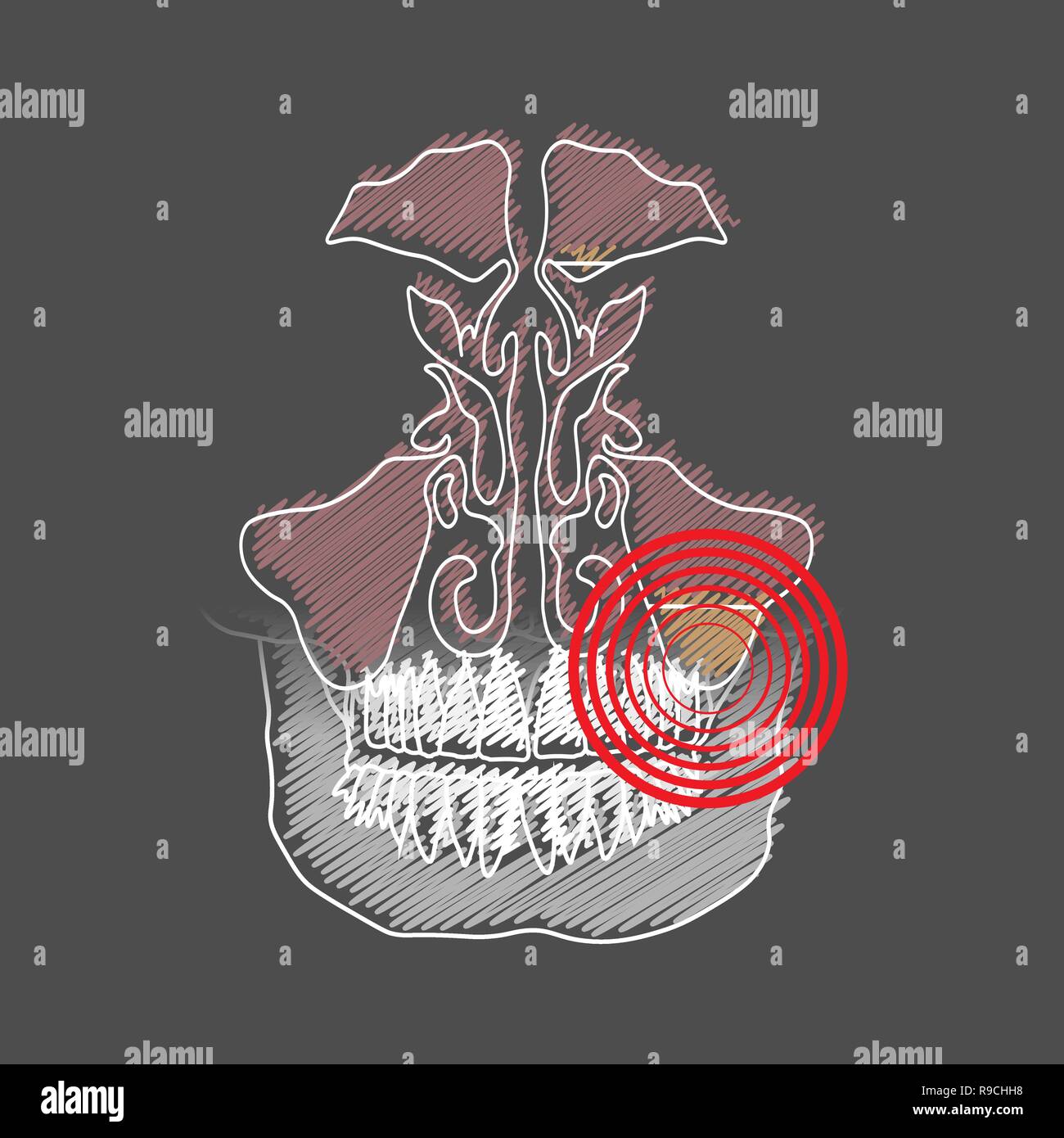 Odontogenic sinusite. Infiammazione dei seni mascellari a causa di una malattia delle radici del dente con un punto di dolore e infiammazione. 10 eps Illustrazione Vettoriale
