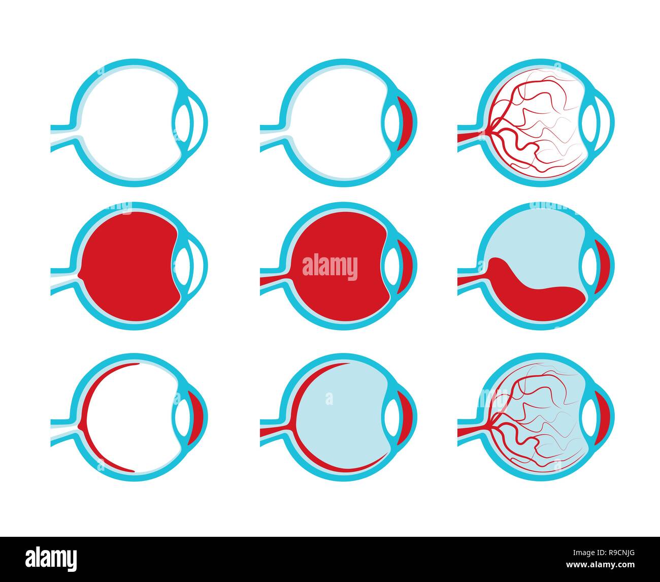 Una sana e malsano gli occhi umani vista laterale illustrazione in sezione sanità mediale, iris Illustrazione Vettoriale