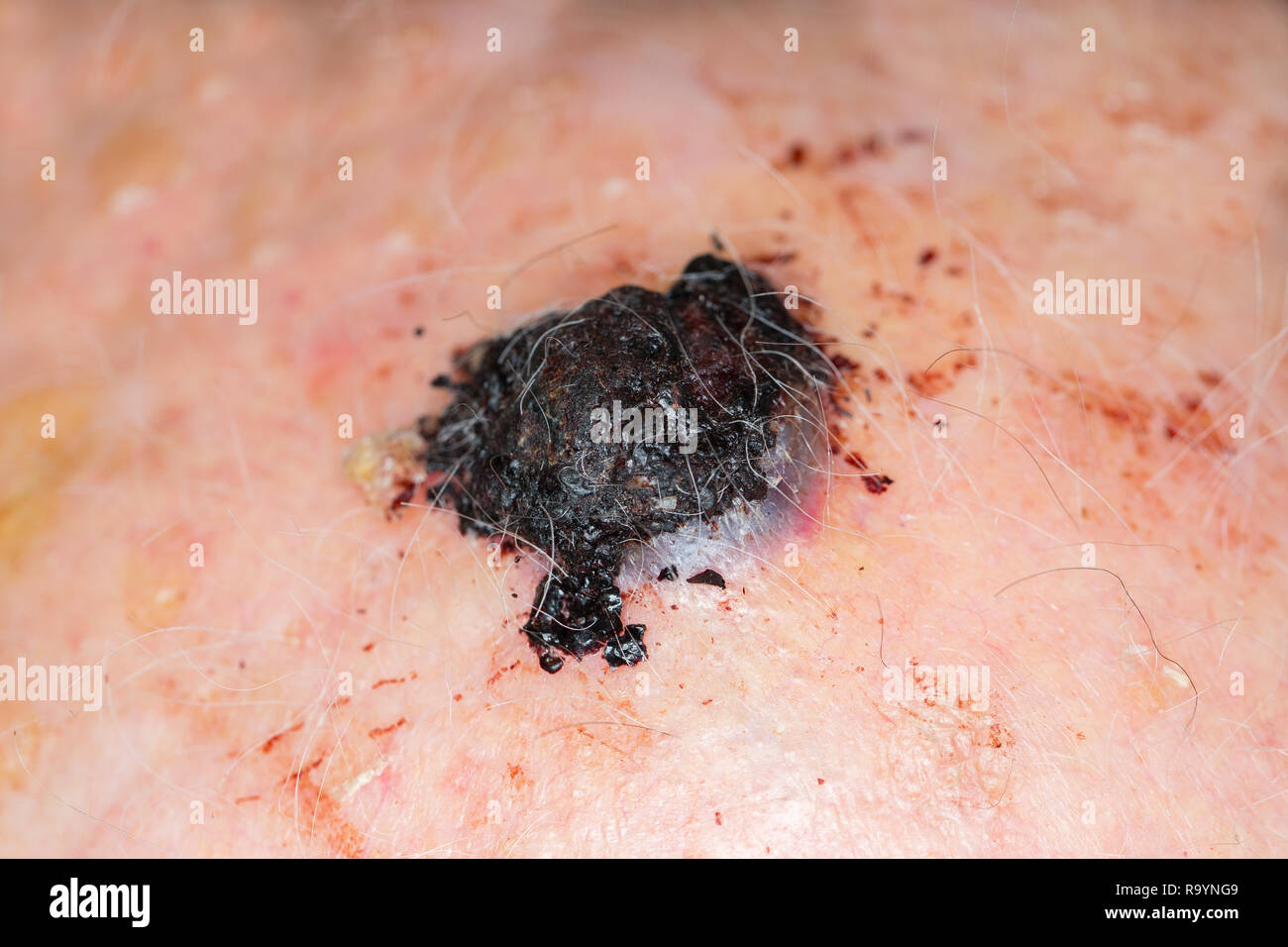 Il melanoma maligno sulla testa di un vecchio uomo caucasico Foto Stock