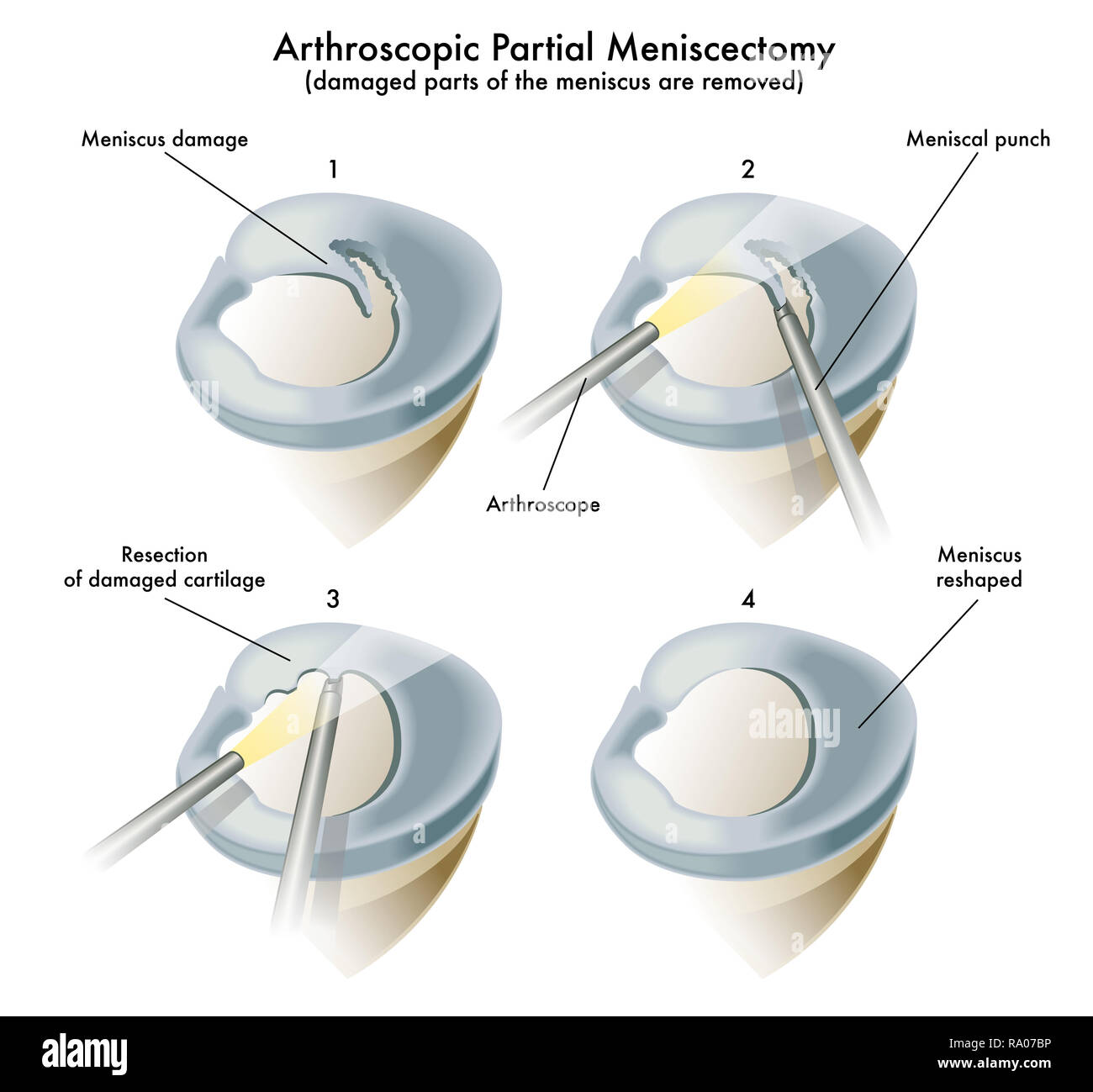 Illustrazione medica di un funzionamento di un parziale artroscopica meniscectomy Foto Stock