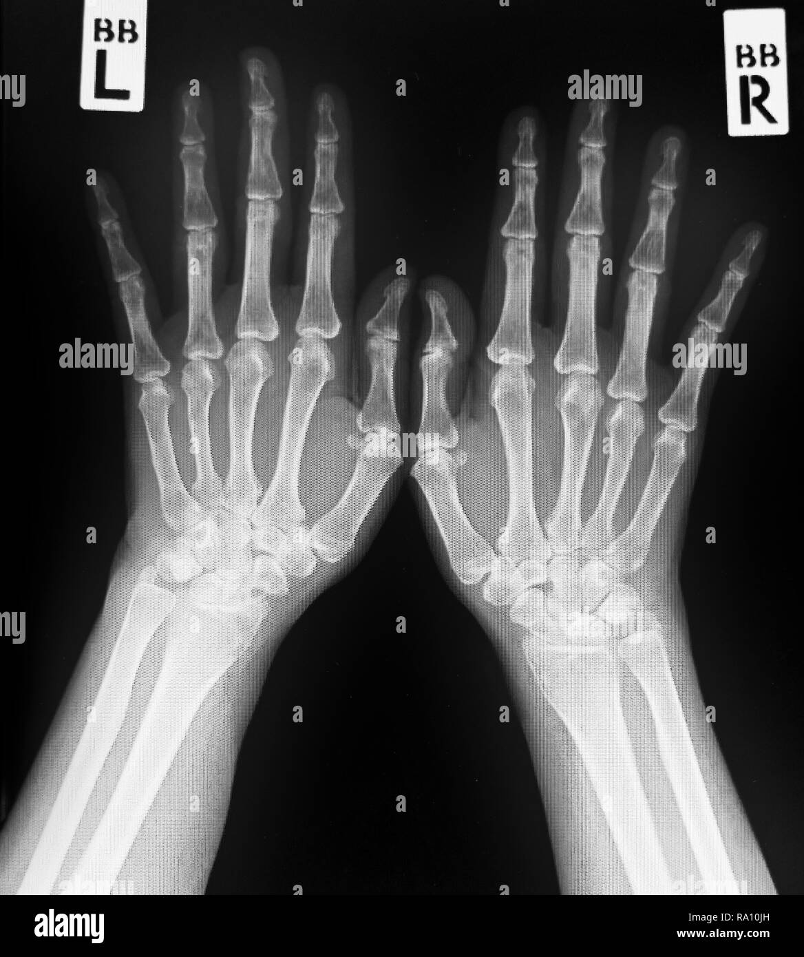 X-ray di entrambe le mani dell'uomo.normale mani umane. Foto Stock