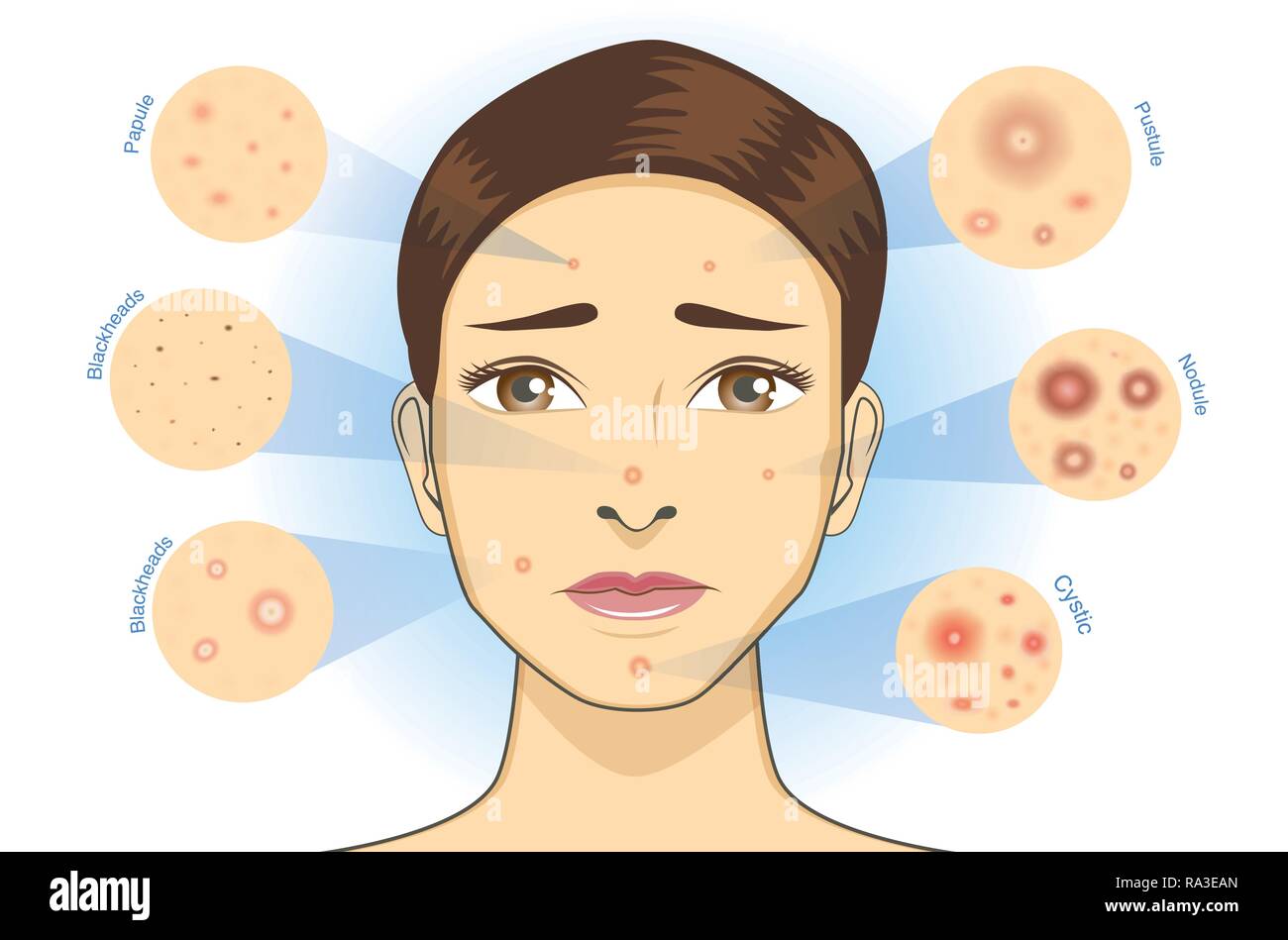 Donna del viso con tipo di acne icona della pelle. Illustrazione Vettoriale