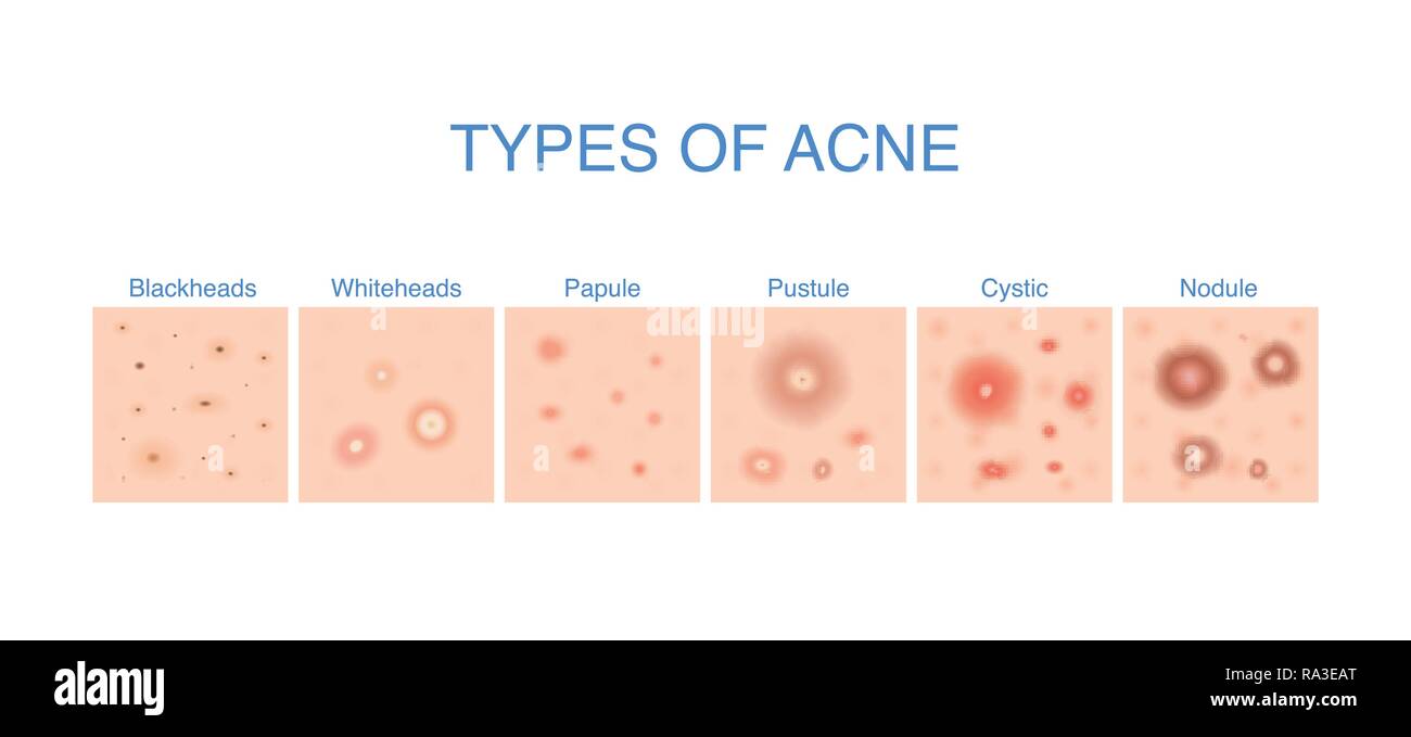 Tipi di acne schema per i problemi della pelle contenuto. Illustrazione Vettoriale