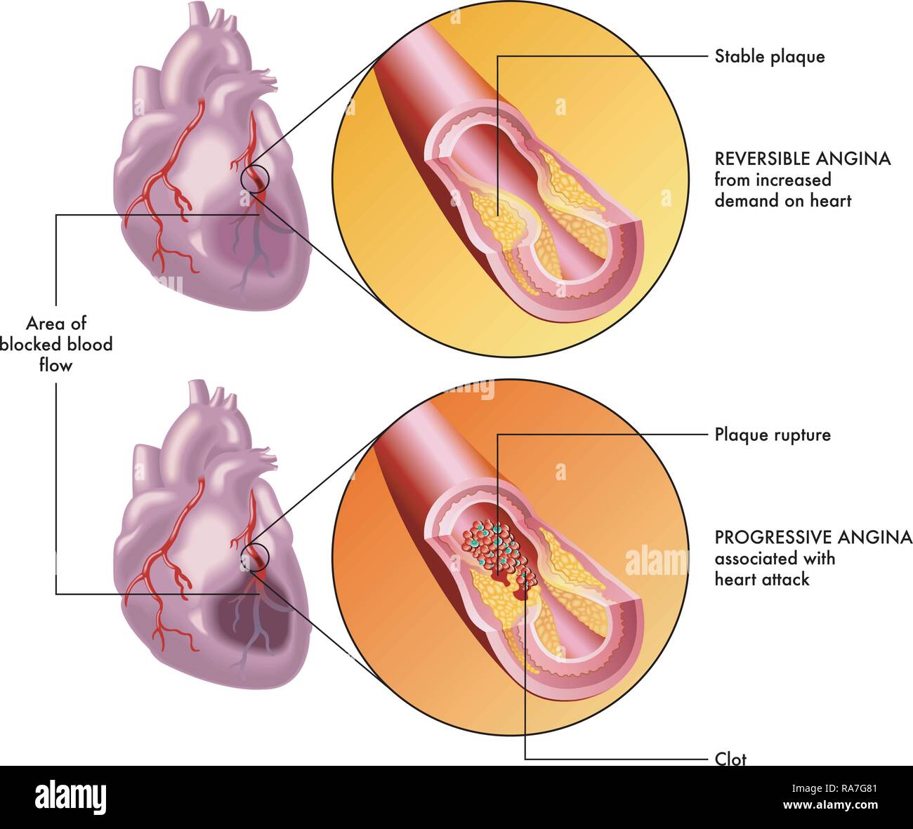 Una illustrazione medica del cuore umano e gli effetti di una reversibile e una progressiva di angina. Illustrazione Vettoriale