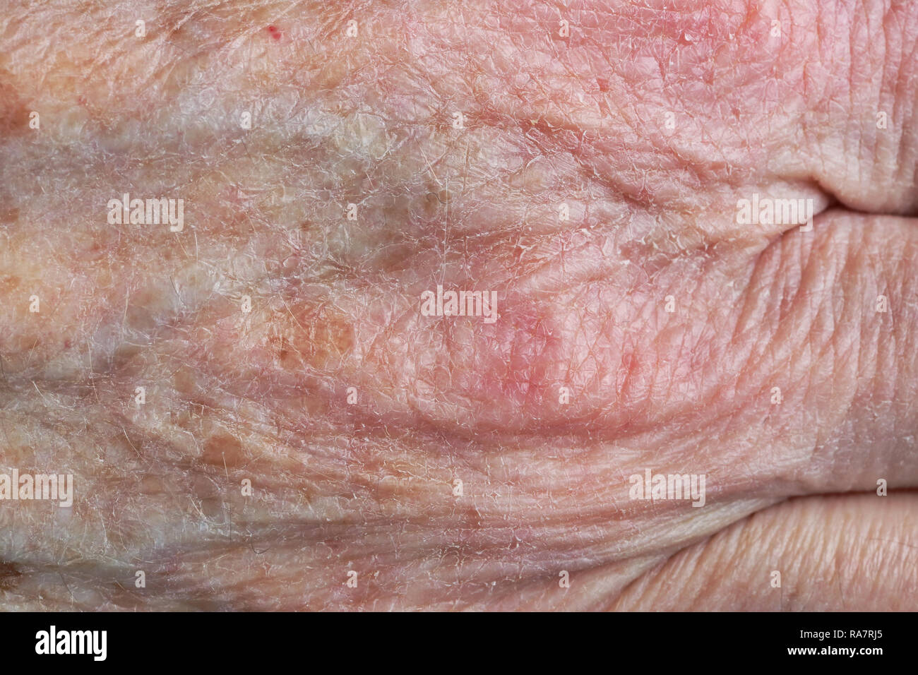 Mal di asciugare la pelle della mano di una donna vecchia nonna. Studio di ripresa macro Foto Stock