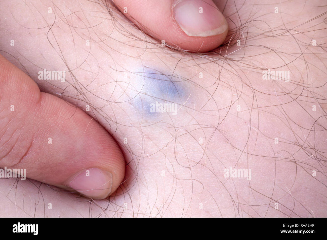 Vena Varicosa Malattia In Un Uomo Primo Piano Immagine Foto Stock Alamy