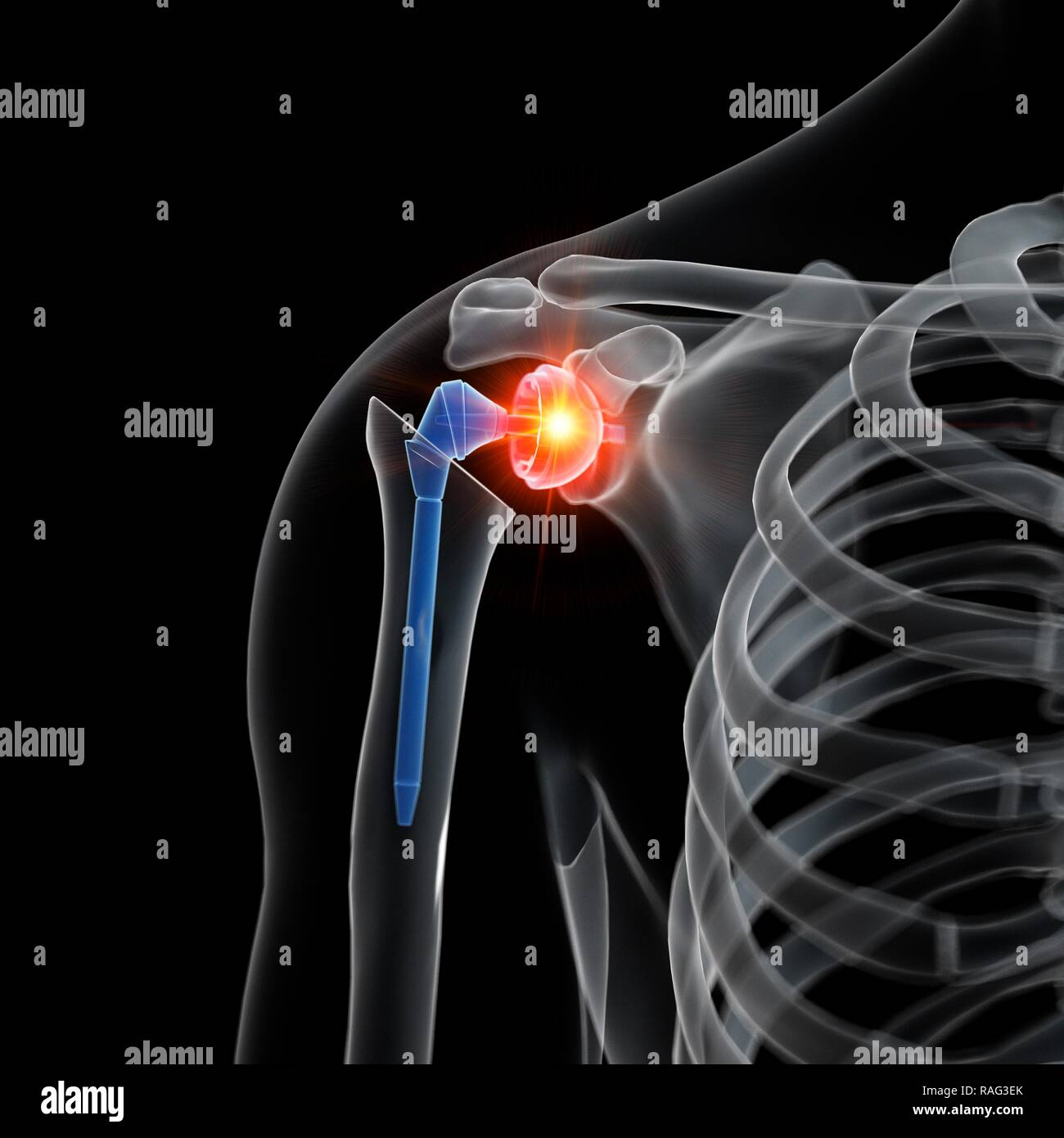 Illustrazione di una spalla di sostituzione. Foto Stock