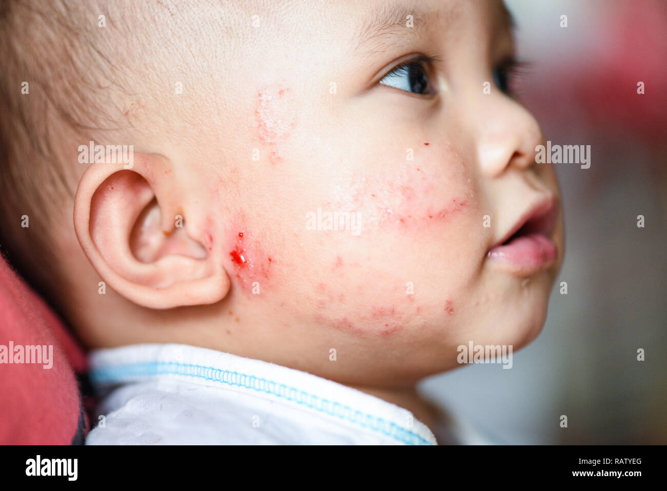 Rash baby allergy sulla faccia / malattia bambina viso Pelle secca prurito  e lesione causata da allergia nel neonato asia Foto stock - Alamy