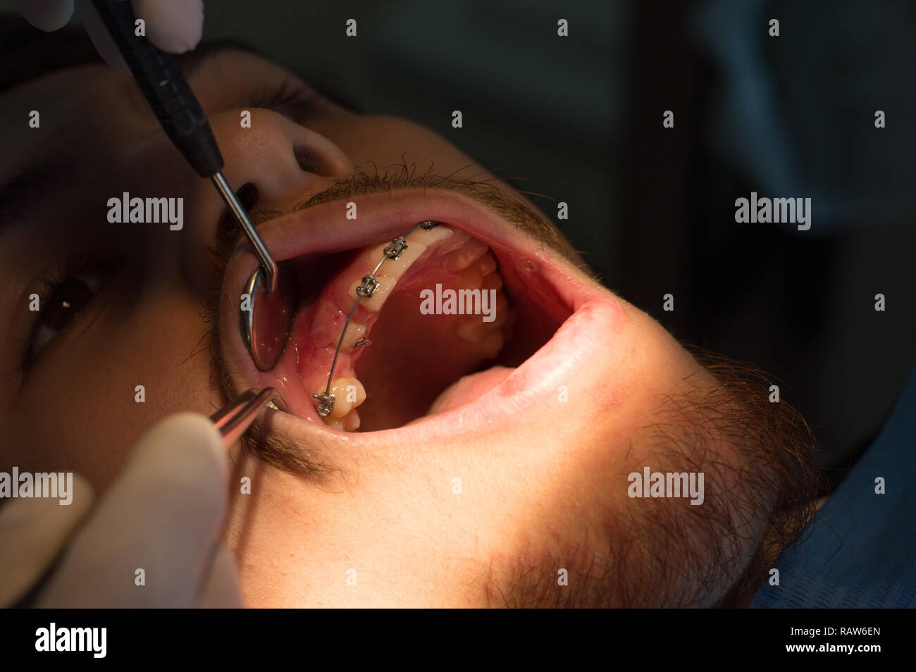 Procedura di ortodonzia. Esposizione di unerupted, dente incluso. Foto Stock