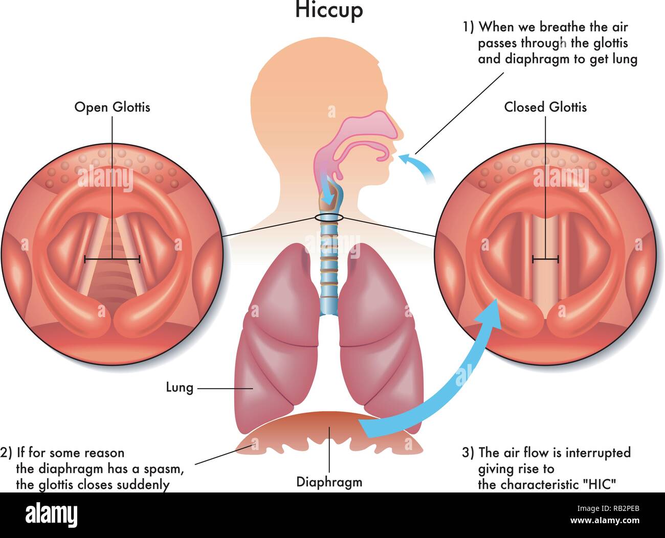 Illustrazione medica dei sintomi e le cause del singhiozzo Illustrazione Vettoriale