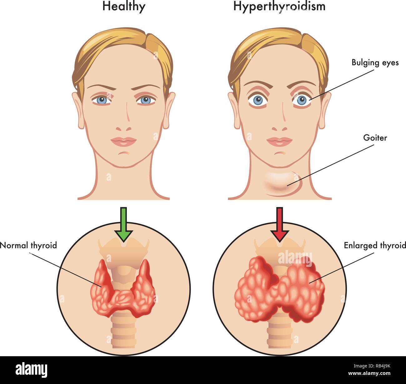Illustrazione medica dei sintomi principali di ipertiroidismo Illustrazione Vettoriale