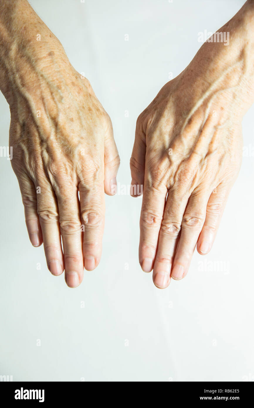 Mani con macchie di vecchiaia Foto stock - Alamy