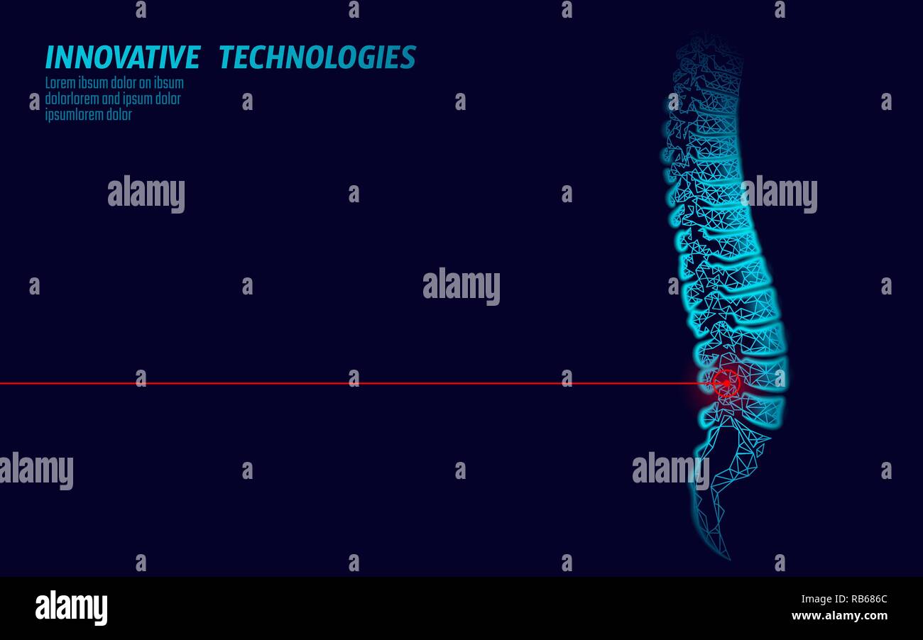 Fisioterapia Laser colonna vertebrale umana pregiudizio. Area di dolore operazione di chirurgia moderna medicina di lombo di bassa tecnologia poli triangoli 3D render femmina ernia posteriore illustrazione vettoriale Illustrazione Vettoriale