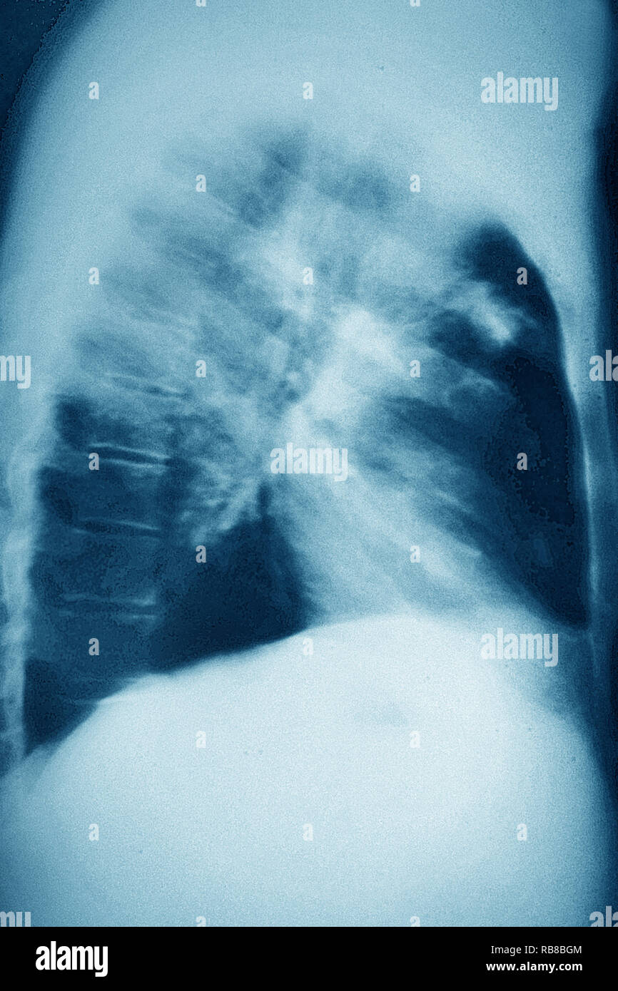 Il cancro del polmone X-RAY Foto Stock