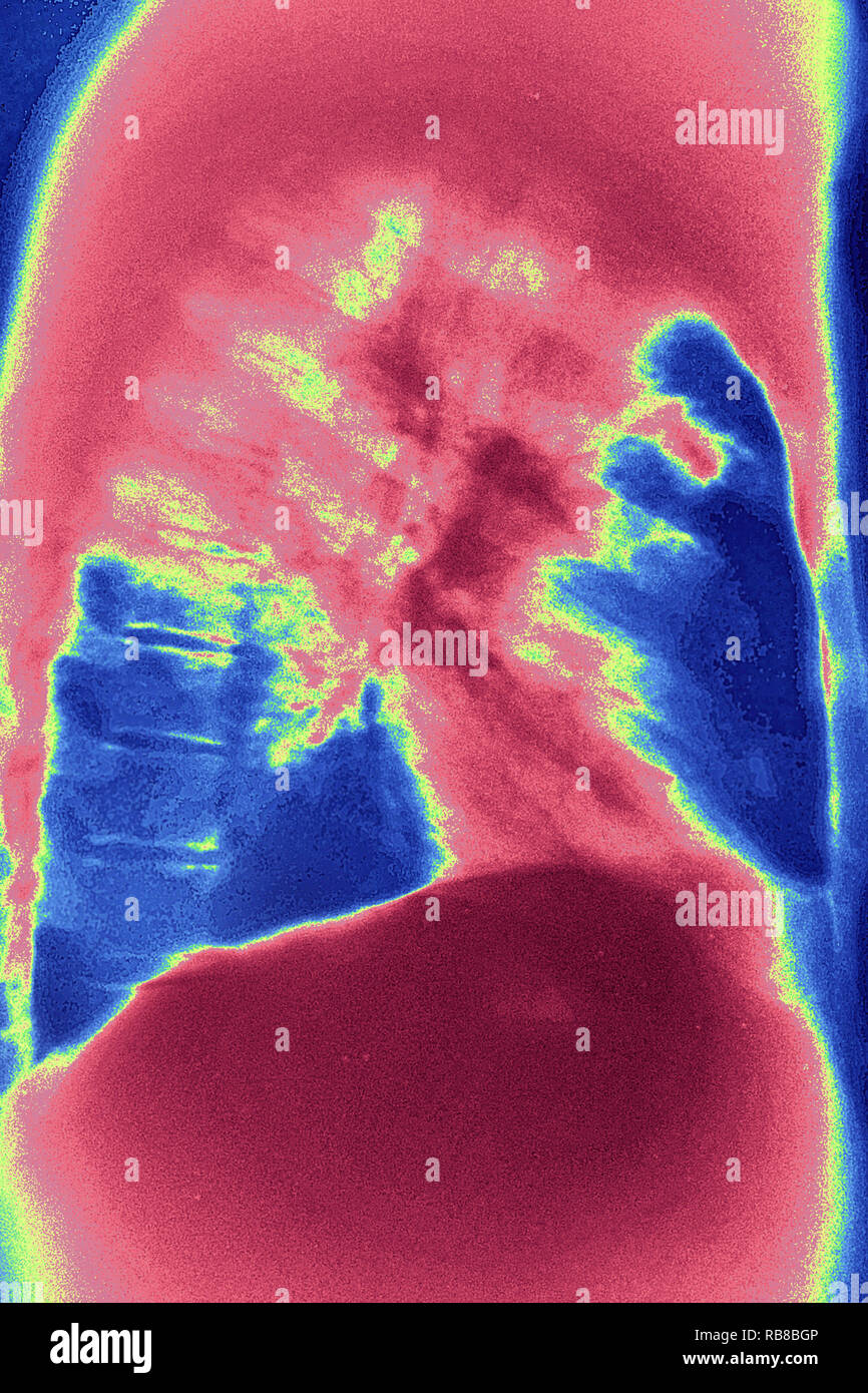 Il cancro del polmone X-RAY Foto Stock