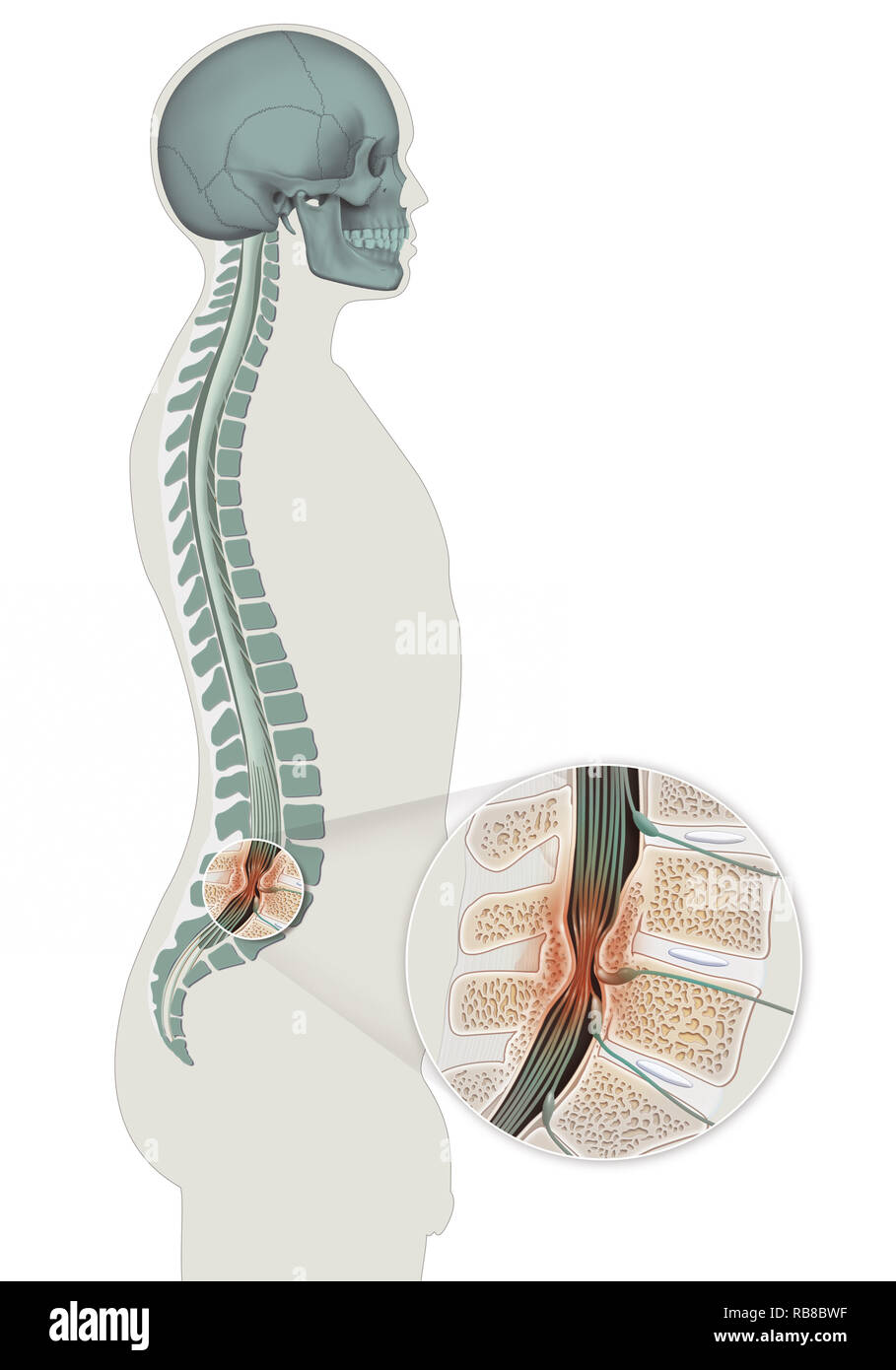La stenosi spinale Foto Stock