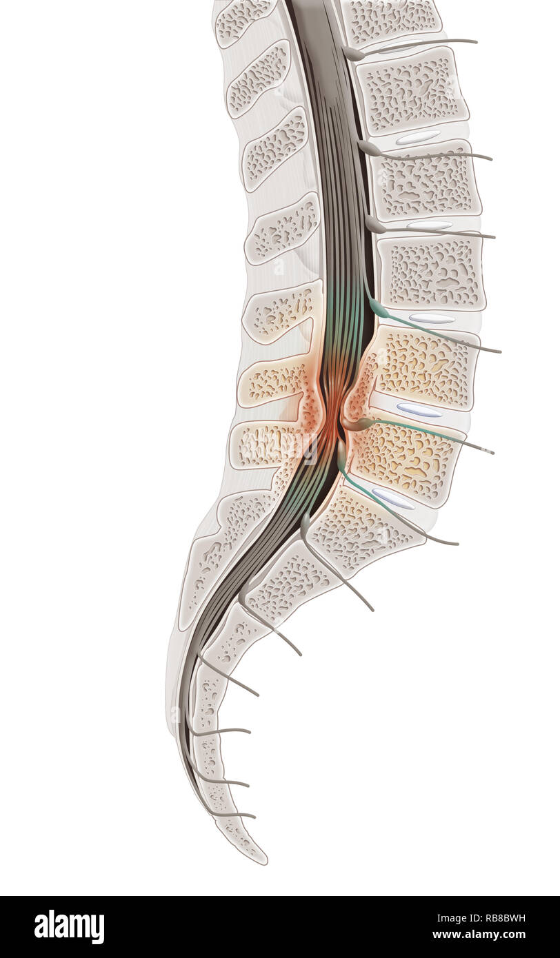 La stenosi spinale Foto Stock