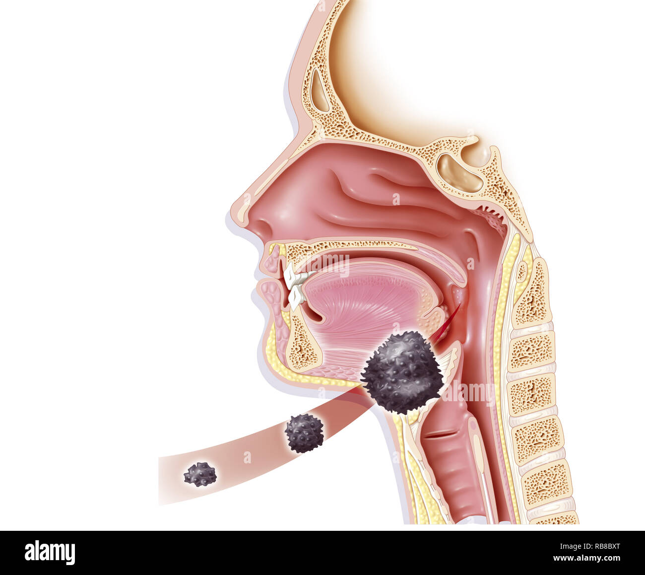 Un cancro alla gola illustrazione Foto Stock