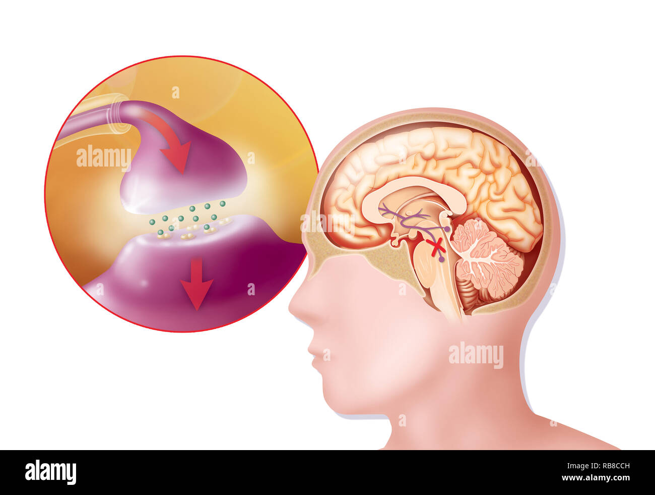 Il Morbo di Parkinson, disegno Foto Stock