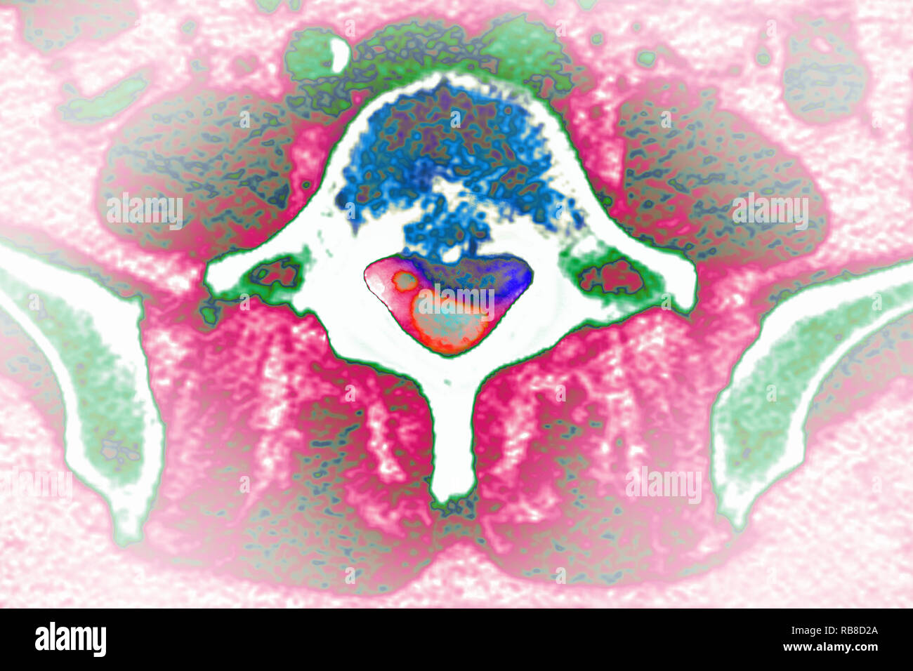 La sindrome di coda di cavallo Foto Stock