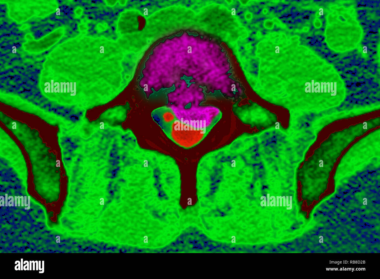 La sindrome di coda di cavallo Foto Stock