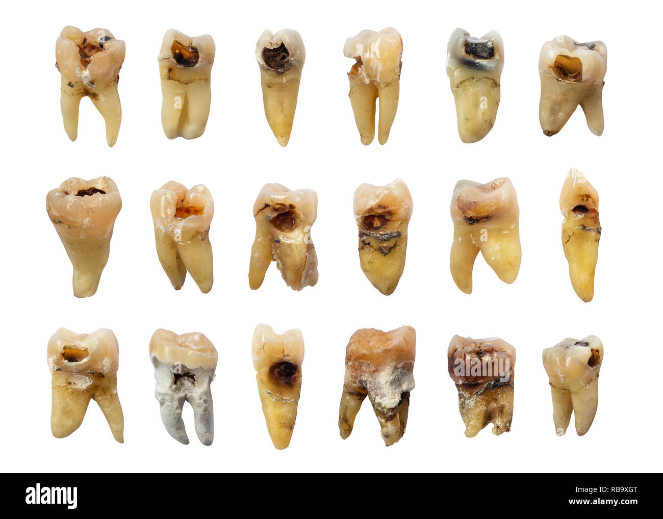 Set di denti con carie dentaria ( carie ) , fluorosi e calcolo . isolato sfondo . Foto Stock
