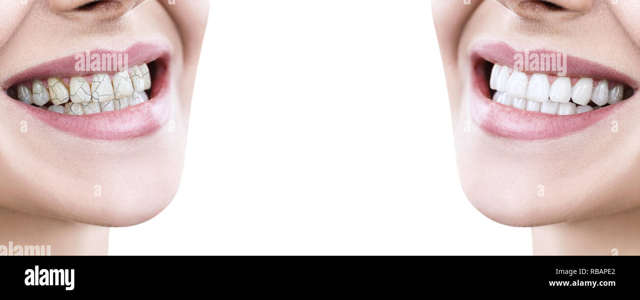 Denti della giovane donna prima e dopo il trattamento. Su sfondo bianco. Foto Stock