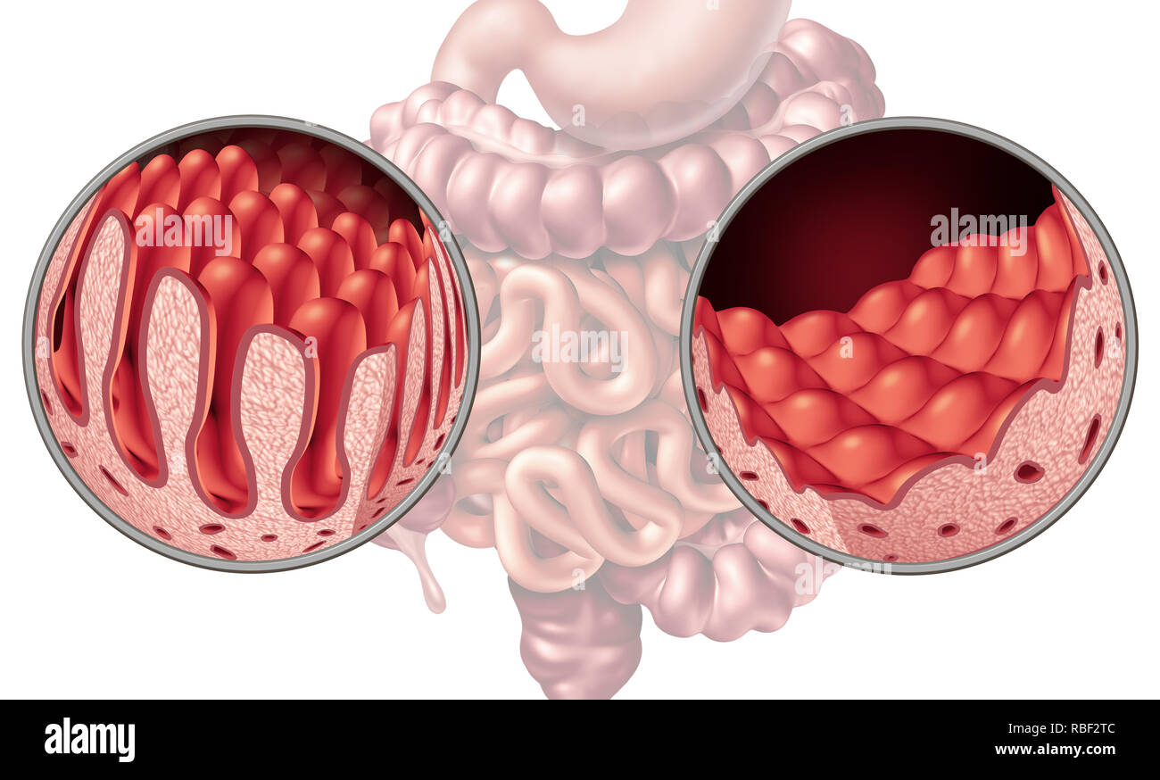 Celiachia celiachia o malattia dell'intestino anatomia concetto medico con normale villi e danneggiato intestino piccolo rivestimento come un disturbo autoimmune. Foto Stock