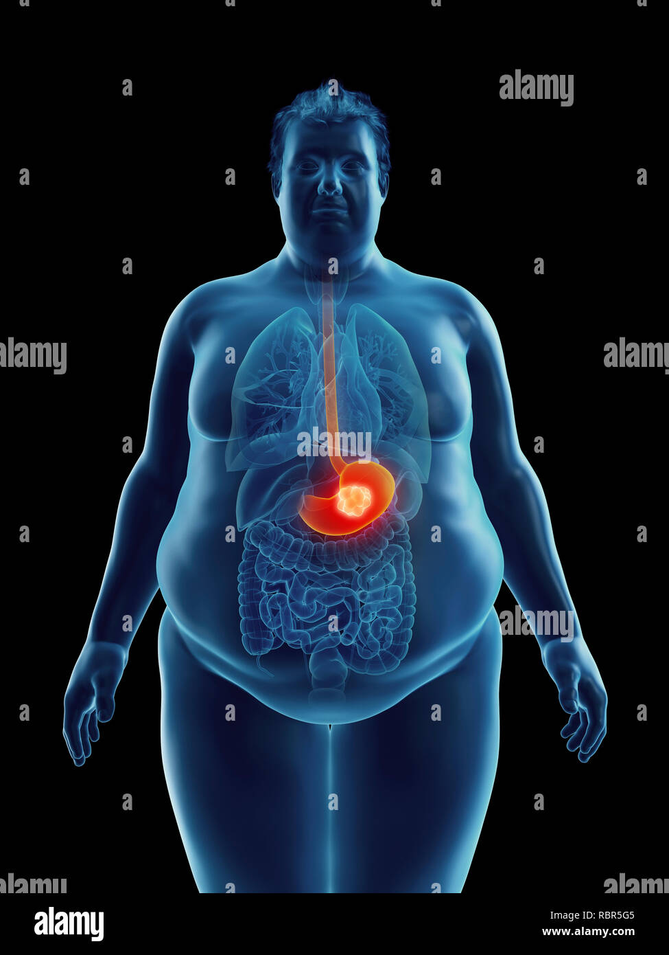 Illustrazione di un obeso dell'uomo un tumore allo stomaco Foto stock
