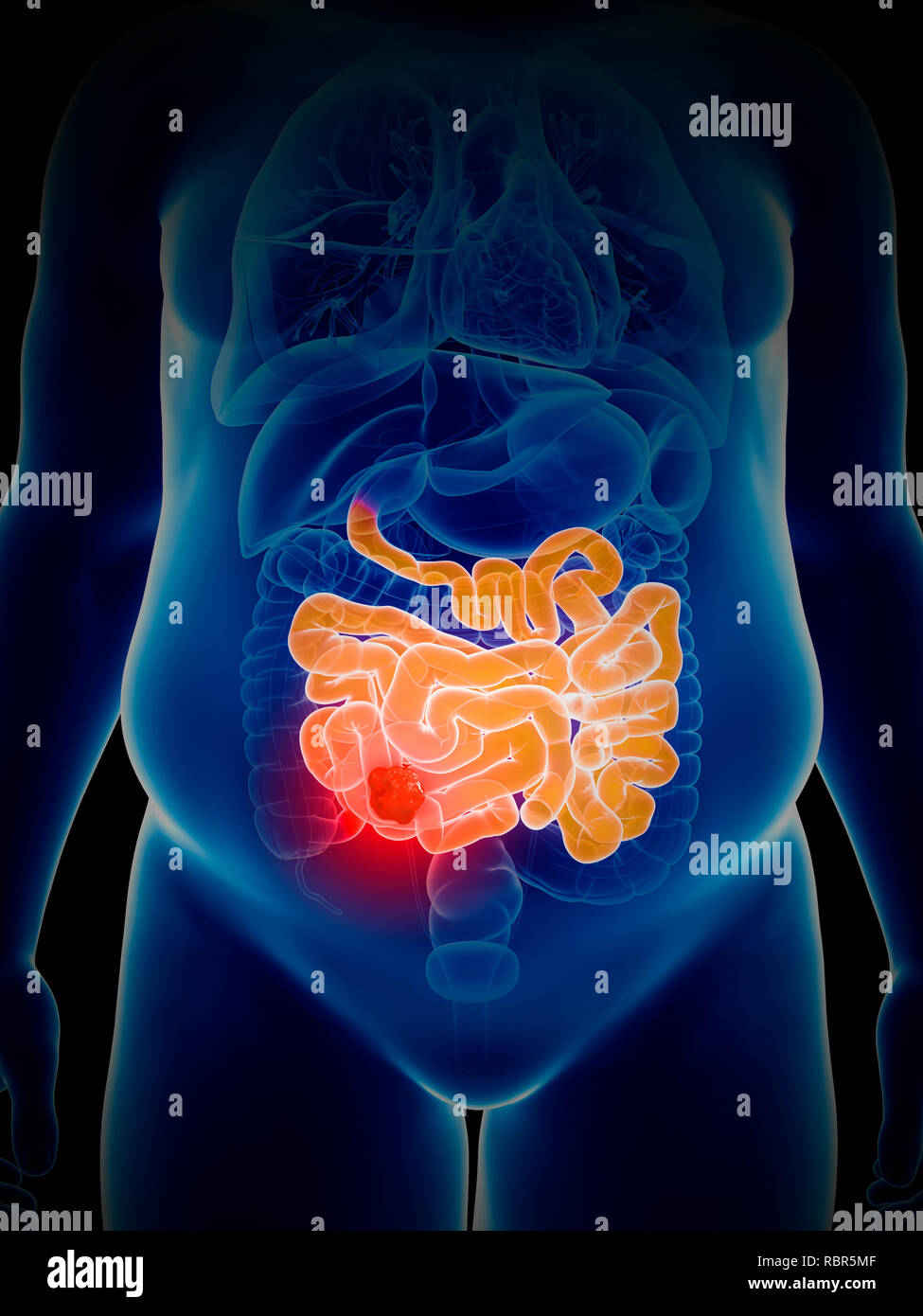 Illustrazione del tumore all'intestino. Foto Stock