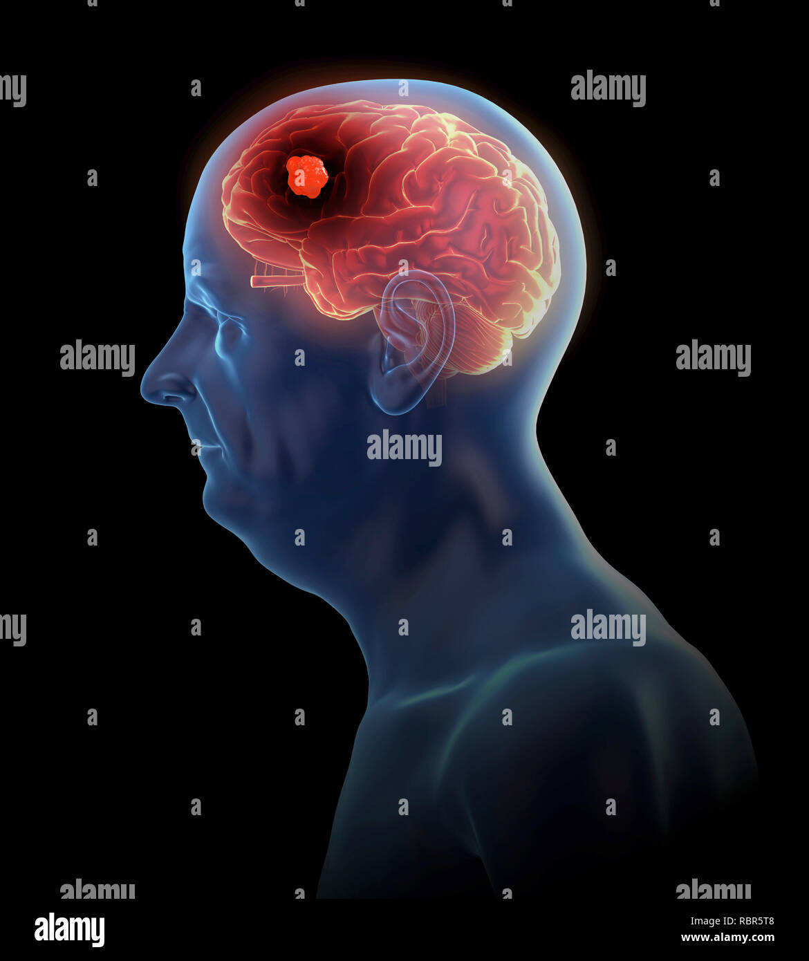 Illustrazione di un tumore al cervello. Foto Stock