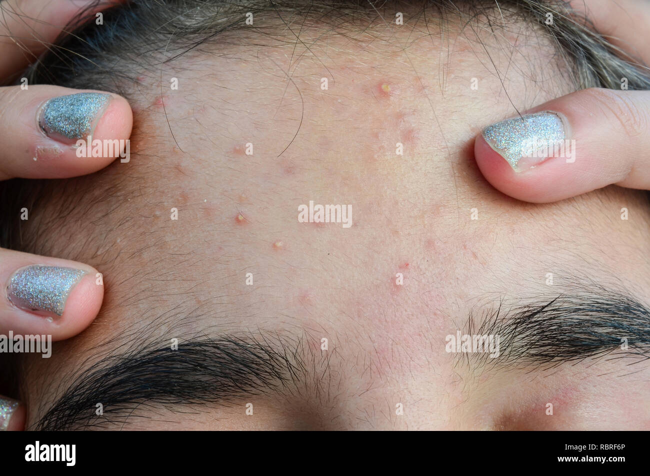 Macro shot di giovani fronte della bambina con il tipico problema con acne  e brufoli alla pubertà Foto stock - Alamy