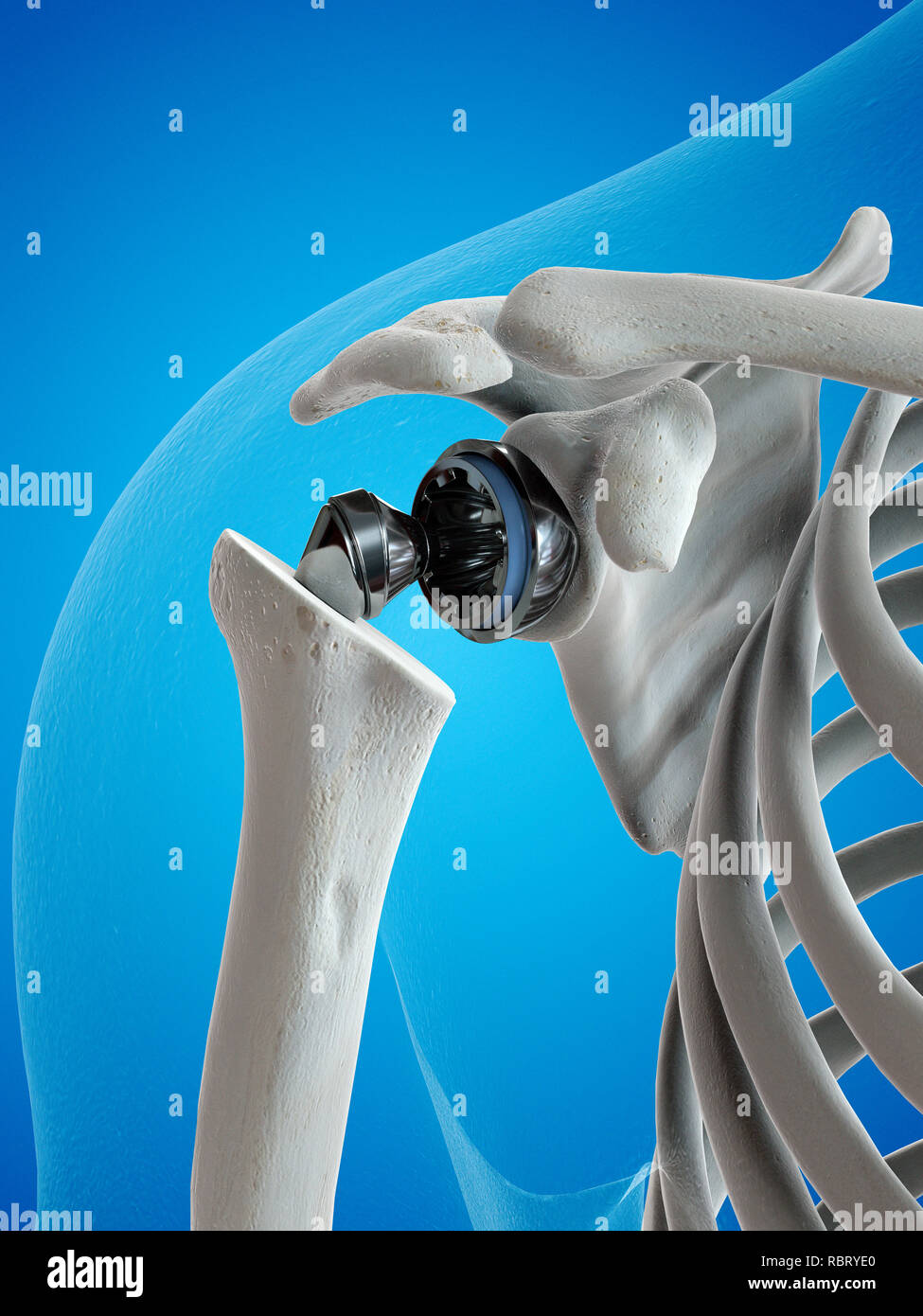 Illustrazione di una spalla di sostituzione. Foto Stock