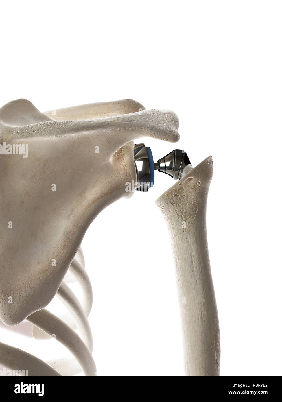 Illustrazione di una spalla di sostituzione. Foto Stock
