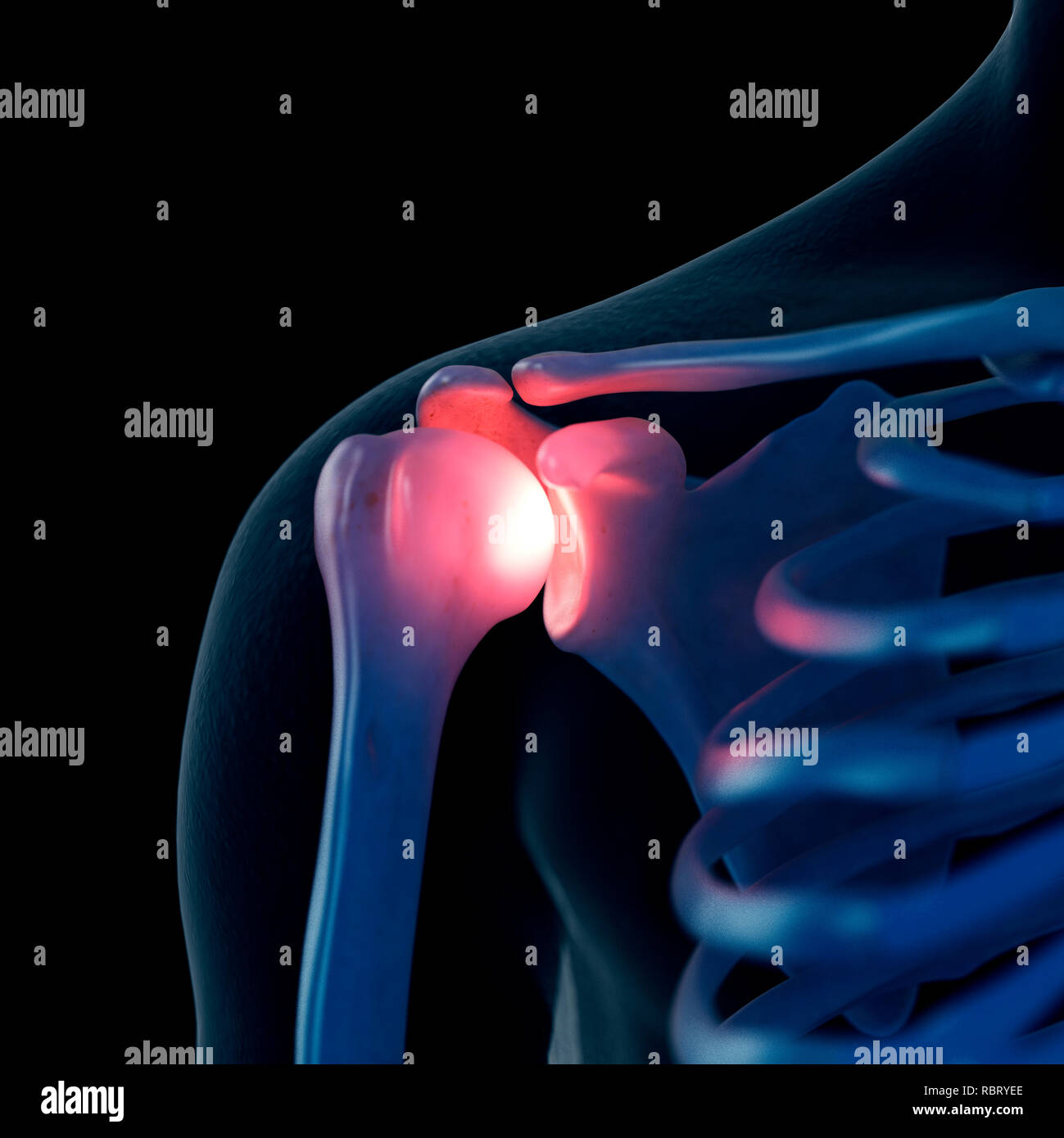 Illustrazione di una spalla dolorosa. Foto Stock