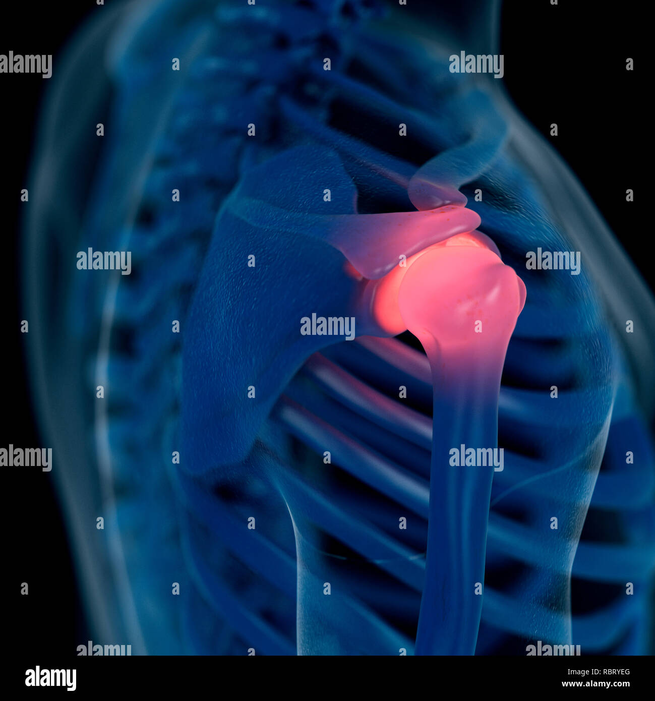 Illustrazione di una spalla dolorosa. Foto Stock