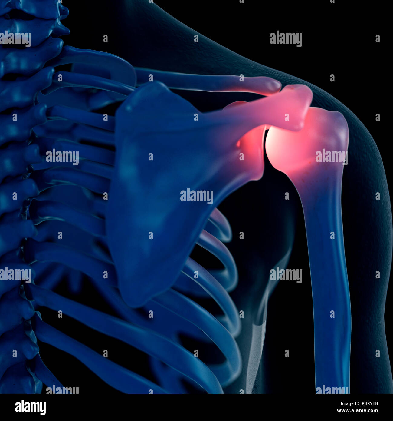 Illustrazione di una spalla dolorosa. Foto Stock