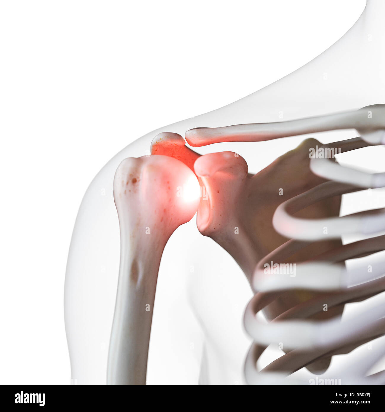 Illustrazione di un doloroso giunto a spalla. Foto Stock