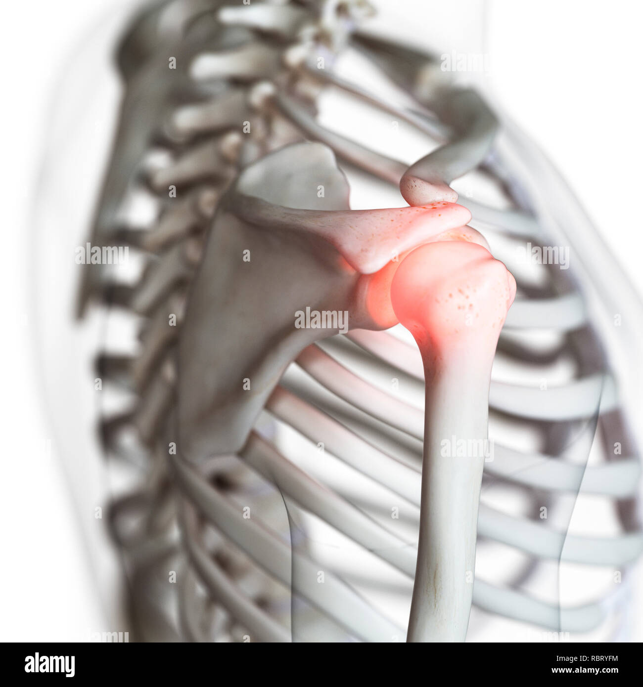 Illustrazione di un doloroso giunto a spalla. Foto Stock
