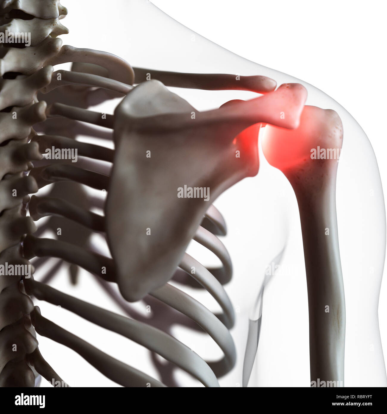 Illustrazione di un doloroso giunto a spalla. Foto Stock