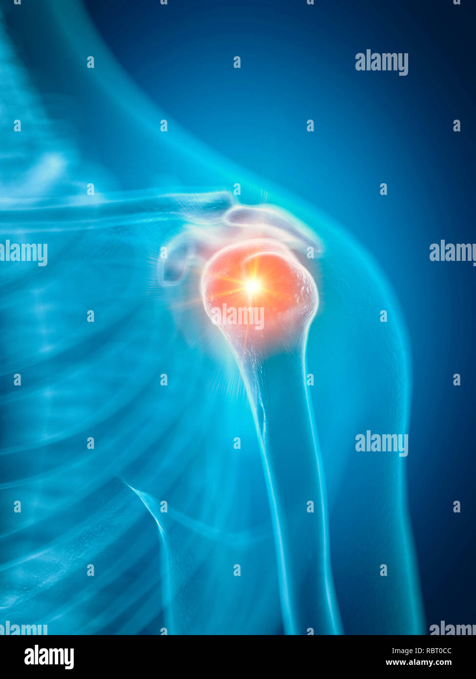 Illustrazione di una spalla dolorosa. Foto Stock