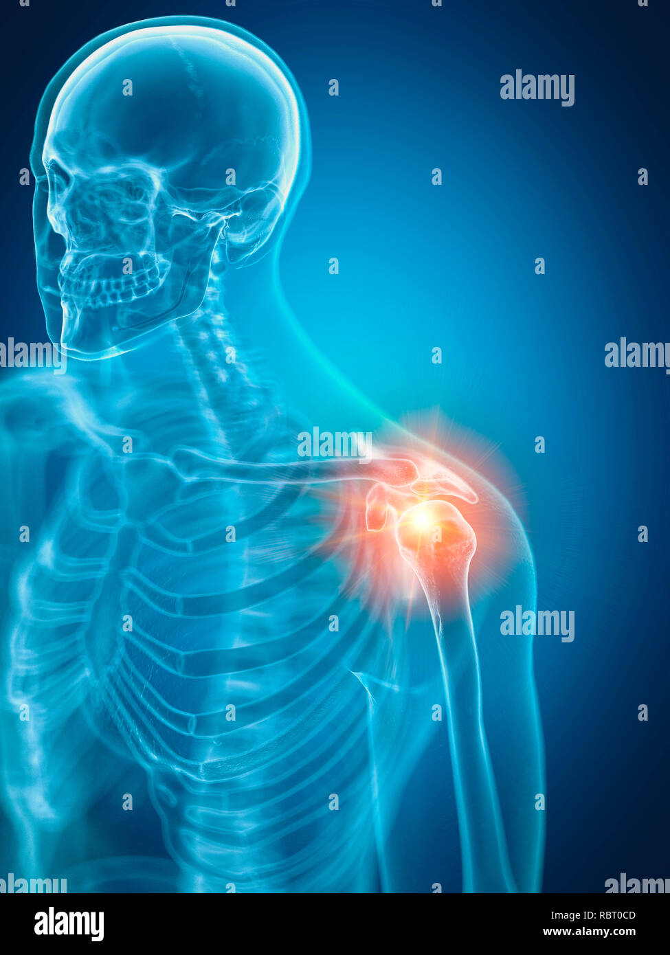 Illustrazione di una spalla dolorosa. Foto Stock